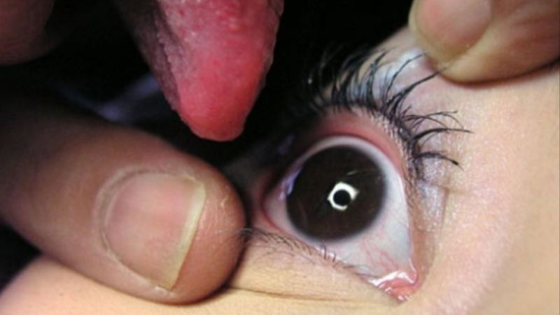 oculolinctus - eyeball licking - obsession addict - lechage de la cornee 1